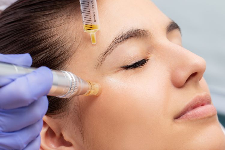 Microneedling (Mesotherapie)